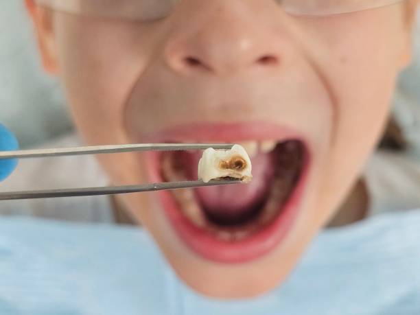 Best Emergency Treatment for Toothache in Robbinsdale, MN